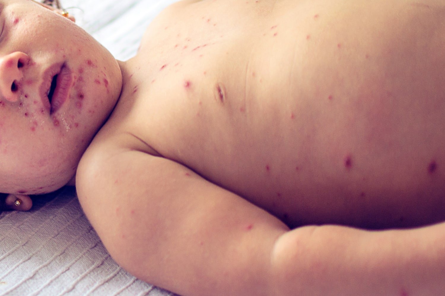 What it’s like to get measles: symptoms, severity and treatment