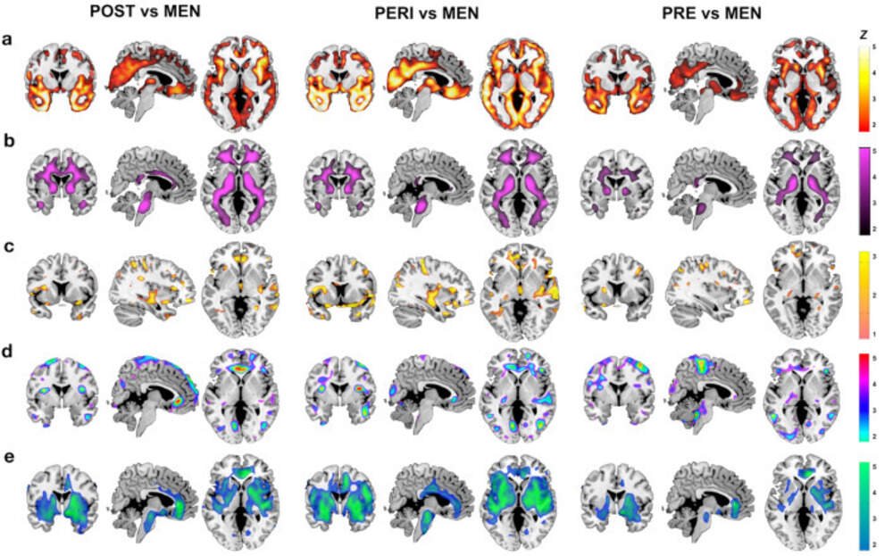 Your brain on menopause | On Point