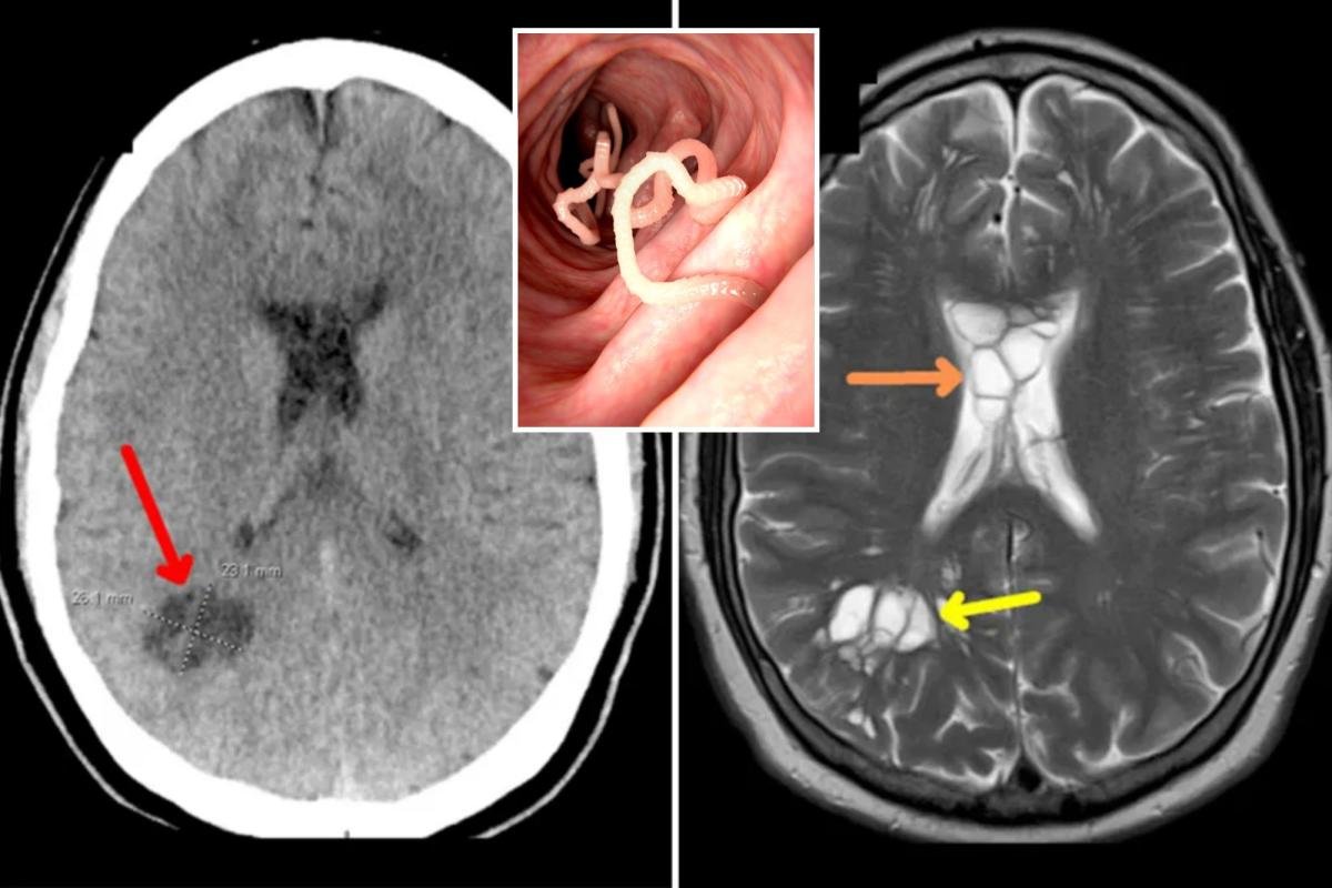 Florida man complains of migraines — docs find tapeworm in his brain from eating undercooked bacon